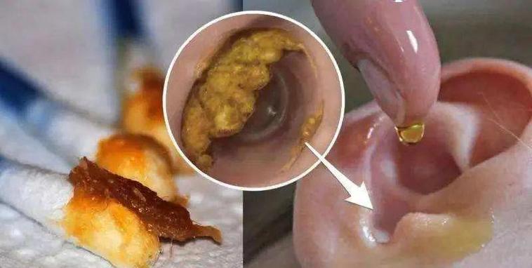 耳屎在鼓膜上多久会掉